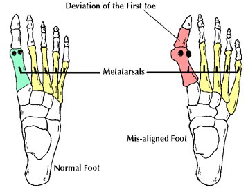 bunions